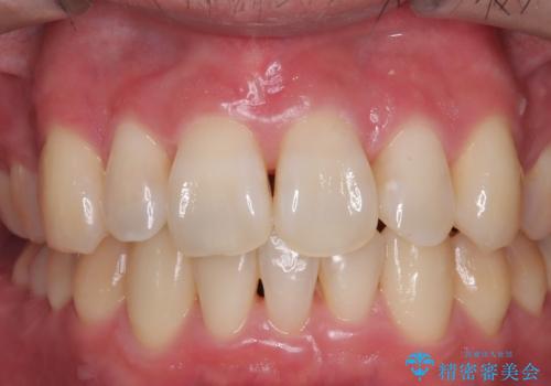 初めてのホワイトニングで、自信と笑顔をゲット!の治療前