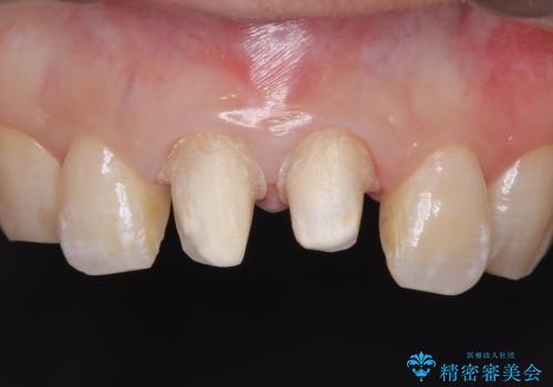 前歯の根のところに違和感がある|根尖性歯周炎|精密根管治療|オールセラミッククラウン|見た目も改善の治療中