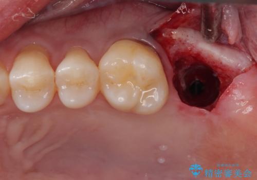 治療途中の虫歯の歯をインプラントにしたい インプラント治療の治療前