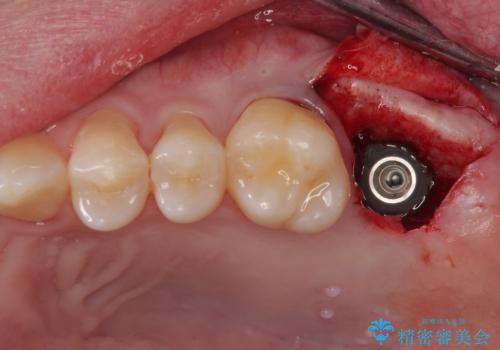 治療途中の虫歯の歯をインプラントにしたい インプラント治療の治療中