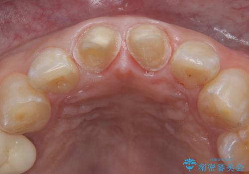 前歯の根のところに違和感がある|根尖性歯周炎|精密根管治療|オールセラミッククラウン|見た目も改善の治療中