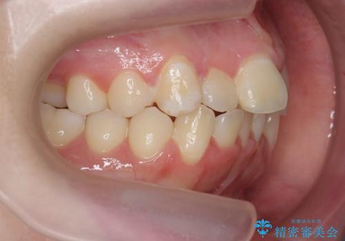 前歯のズレ・がたつき・すれ違いの矯正治療の治療前