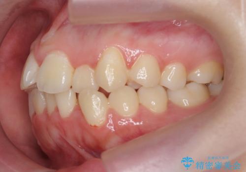 前歯のズレ・がたつき・すれ違いの矯正治療の治療前