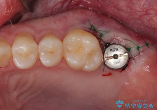 治療途中の虫歯の歯をインプラントにしたい インプラント治療の治療中