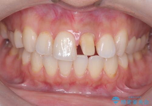 前歯の色が気になる!|オールセラミッククラウンの治療中