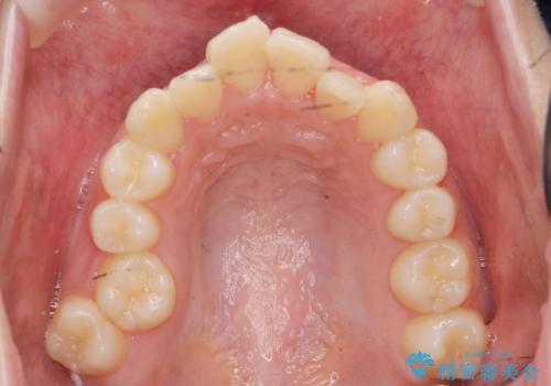 前歯のズレ・がたつき・すれ違いの矯正治療の治療前
