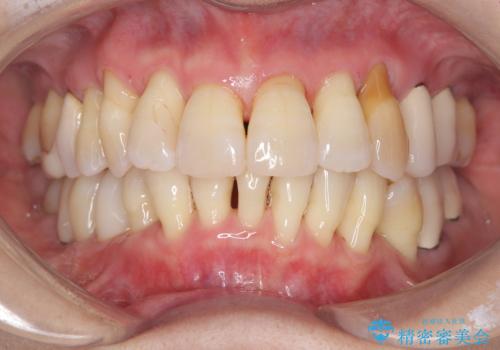 歯茎が下がっているかたエアーフローを特にお勧めしますの症例 治療後