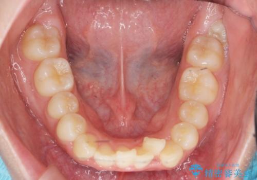 前歯のズレ・がたつき・すれ違いの矯正治療の治療前