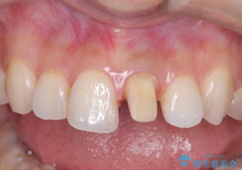 前歯の色が気になる!|オールセラミッククラウンの治療中