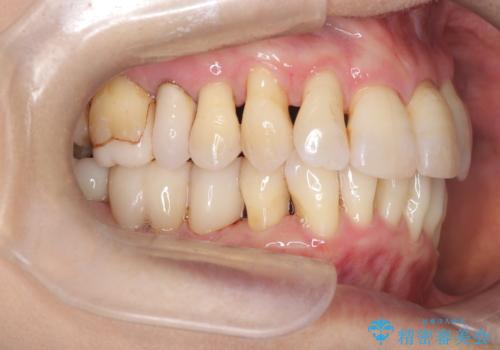 歯茎が下がっているかたエアーフローを特にお勧めしますの治療後