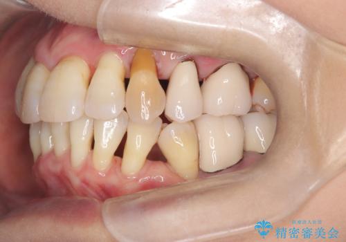 歯茎が下がっているかたエアーフローを特にお勧めしますの治療後