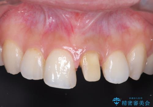 前歯の色が気になる!|オールセラミッククラウンの治療中