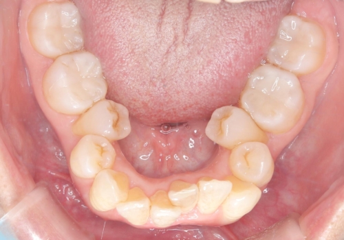 【セラミックインレー】口の中の銀の詰め物を白い物に替えたいの治療後