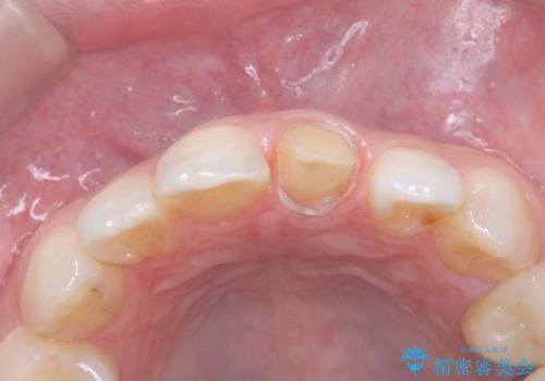 前歯の色が気になる!|オールセラミッククラウンの治療中