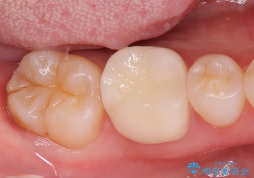 歯が欠けた <セラミッククラウン>