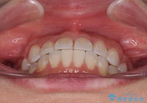 【モニター】八重歯と正中を改善 ワイヤー装置の抜歯矯正の治療後