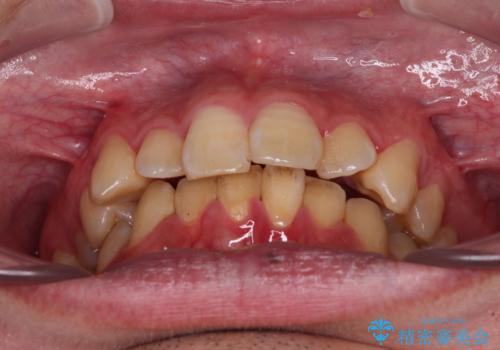 上顎前歯のデコボコを改善してスッキリした口元に ワイヤー装置での非抜歯矯正の治療前