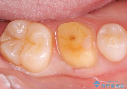 歯が欠けた <セラミッククラウン>の治療中