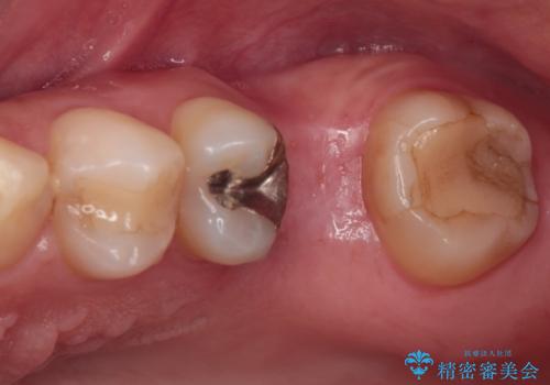 割れてしまった奥歯 インプラント治療の治療中