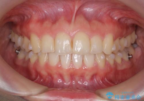 出っ歯に見える前歯の改善 部分ワイヤーとマウスピース矯正の治療中