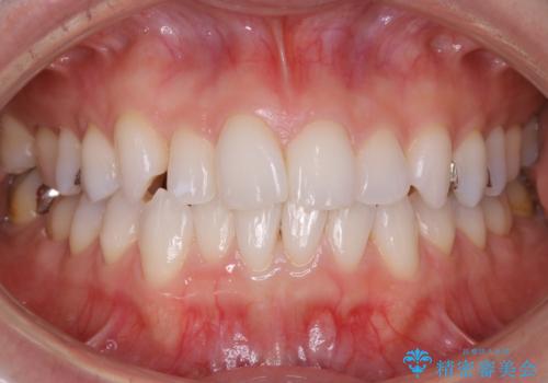 マウスピースの症例 治療前