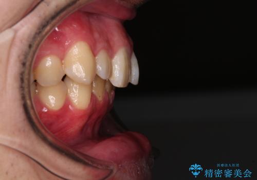 上顎前歯のデコボコを改善してスッキリした口元に ワイヤー装置での非抜歯矯正