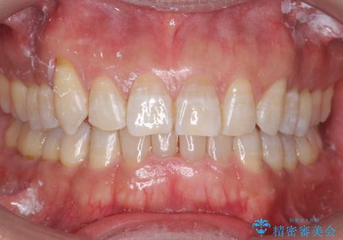 八重歯と下の歯のがたつき マウスピースでの治療中