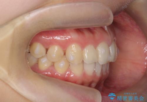 出っ歯に見える前歯の改善 部分ワイヤーとマウスピース矯正の治療中