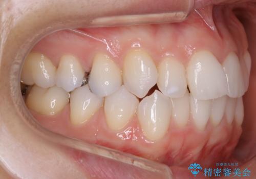 【非抜歯】マウスピースで短期間矯正の治療前