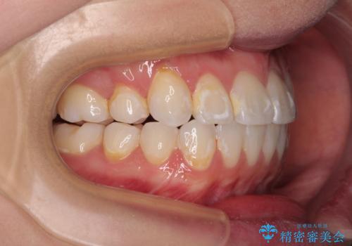 【モニター】八重歯と正中を改善 ワイヤー装置の抜歯矯正の治療後