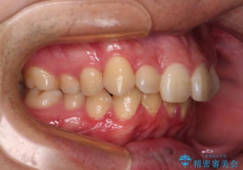 上顎前歯のデコボコを改善してスッキリした口元に ワイヤー装置での非抜歯矯正の治療前