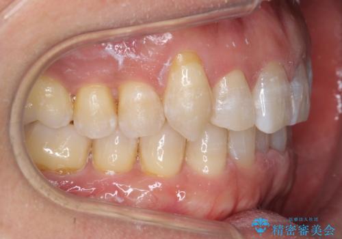 八重歯と下の歯のがたつき マウスピースでの治療中