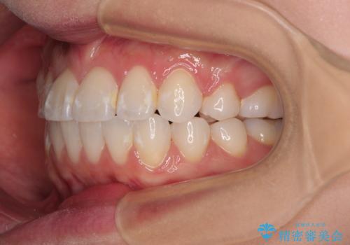 【モニター】八重歯と正中を改善 ワイヤー装置の抜歯矯正の治療後