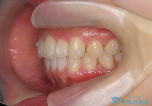 出っ歯に見える前歯の改善 部分ワイヤーとマウスピース矯正の治療中