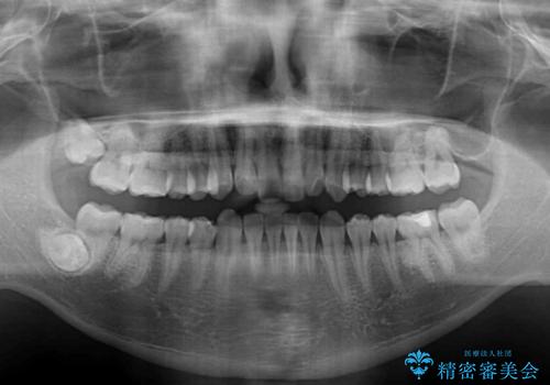 上顎前歯のデコボコを改善してスッキリした口元に ワイヤー装置での非抜歯矯正の治療前