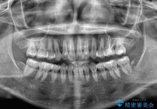 インビザライン・モデレートを用いて気になる後戻りを矯正治療の治療前