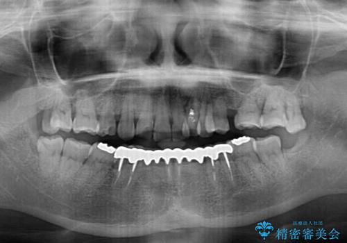 外れるブリッジと気になる八重歯 総合歯科治療で美しい口元にの治療前