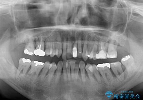歯周病でグラグラの歯 矯正治療と歯周外科を併用した総合歯科治療の治療前