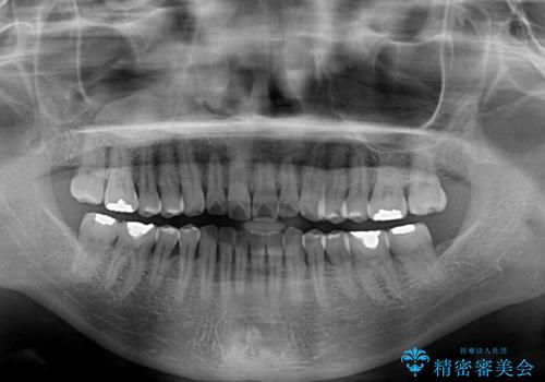 前歯のデコボコをインビザライン・モデレートで矯正治療の治療前