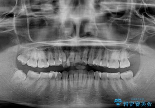 【モニター】八重歯と正中を改善 ワイヤー装置の抜歯矯正の治療前
