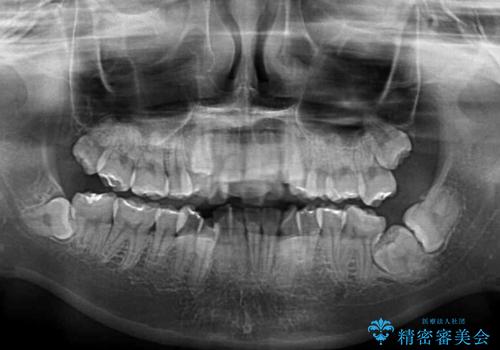 転位歯や埋伏歯などの難易度の高い抜歯矯正治療の治療前
