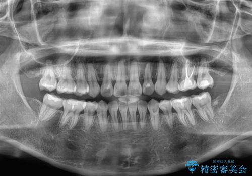 インビザライン・モデレートを用いて気になる後戻りを矯正治療の治療後