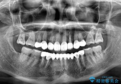 外れるブリッジと気になる八重歯 総合歯科治療で美しい口元にの治療後