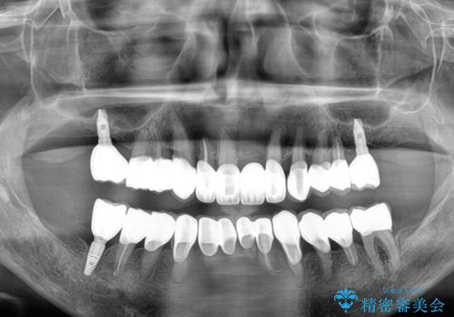 歯周病でグラグラの歯 矯正治療と歯周外科を併用した総合歯科治療の治療後