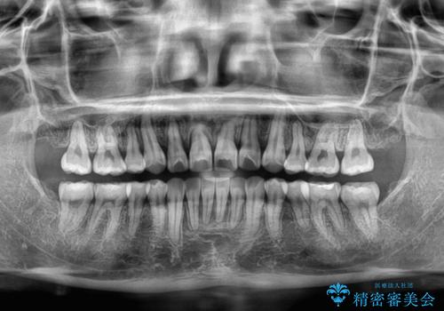 【モニター】八重歯と正中を改善 ワイヤー装置の抜歯矯正の治療後