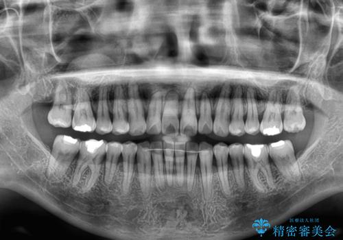 前歯のデコボコをインビザライン・モデレートで矯正治療の治療後