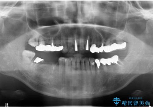 全顎 虫歯 インプラント治療の治療前
