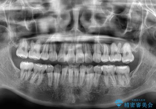 転位歯や埋伏歯などの難易度の高い抜歯矯正治療の治療後