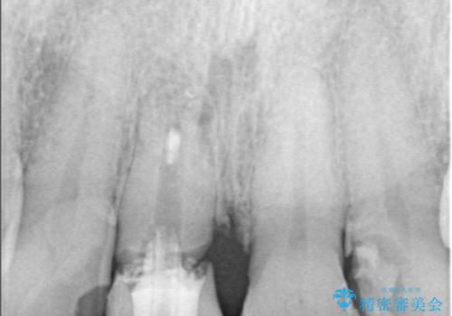 折れた前歯を即時インプラントで回復の治療前