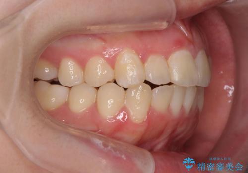 前歯のズレ・がたつき・すれ違いの矯正治療の治療後